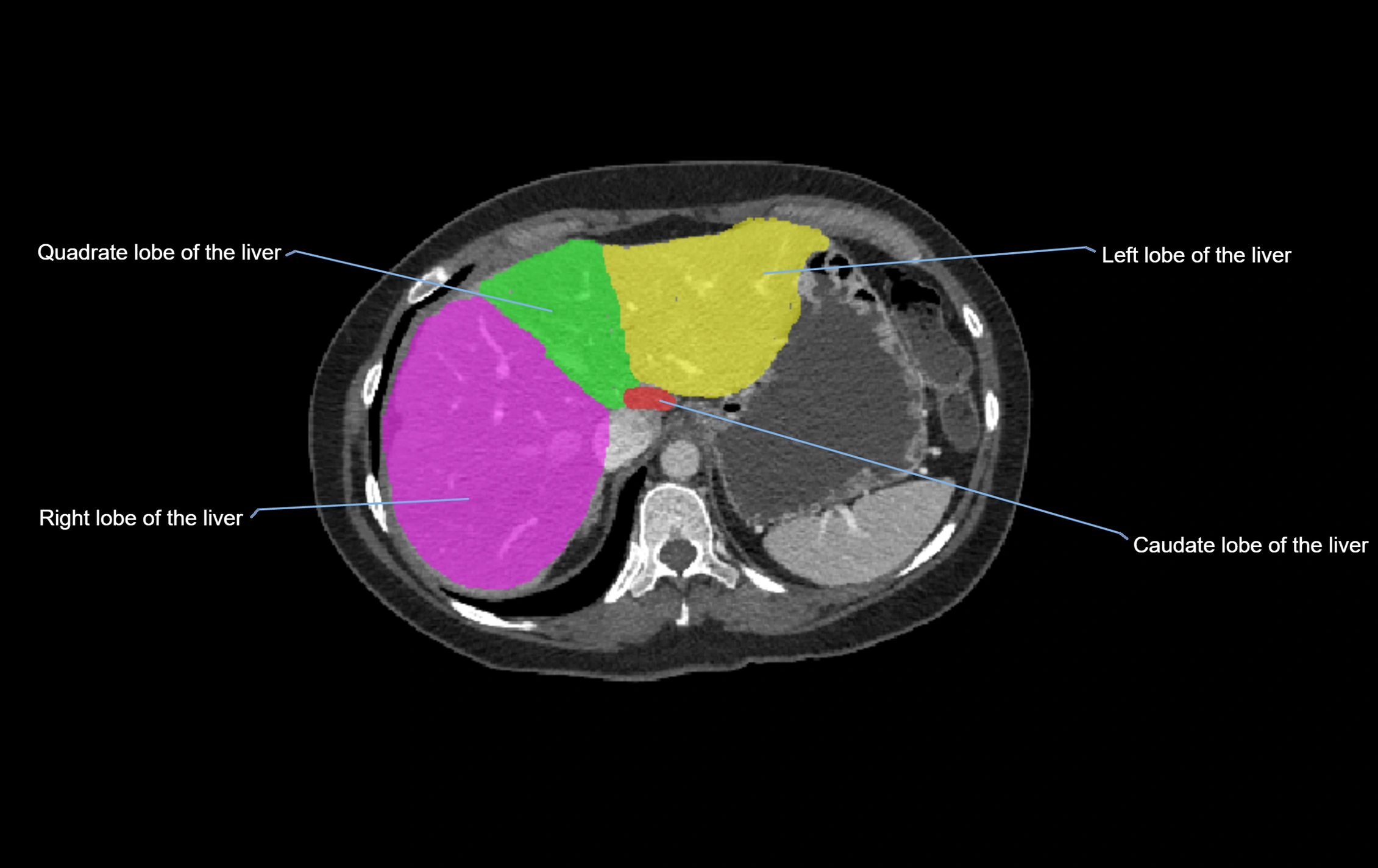 CT lliver lobes axial cross sectional anatomy labelled image -00057.webp
